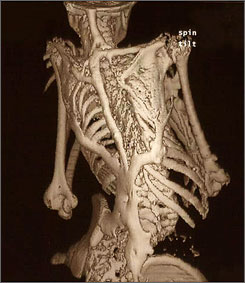 4-Year-Old Grows Second Skeleton