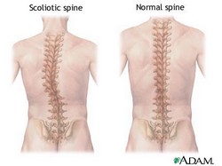Scoliosis: The Forgotten Disease?