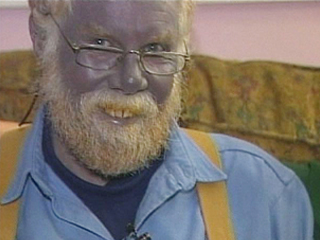 Real life 'blue man' Paul Karason dies aged 62; turned blue after drinking  colloidal silver to help skin