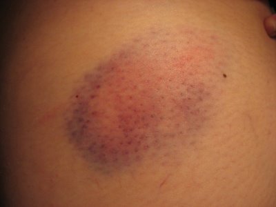 Pictures Of Bruises On Skin 111