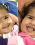 Conjoined Twins' Separation a Success