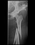 A shattered femur - a good ending to the weekend